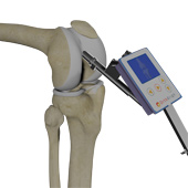 Knee Replacement with OrthAlign Technology