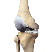 Partial Medial Knee Replacement