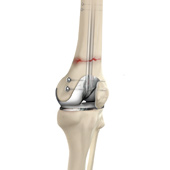 Periprosthetic Knee Fractures